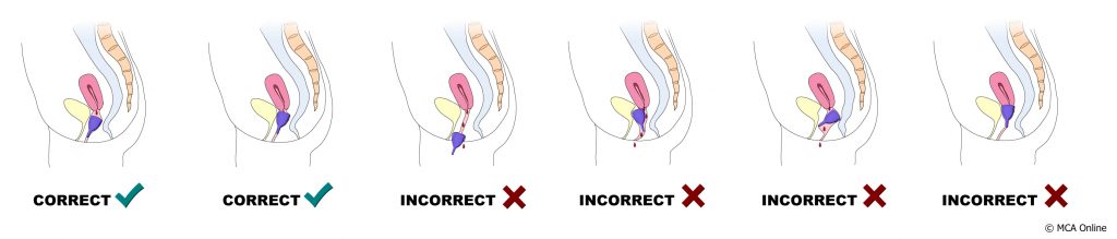 Correct menstrual cup positioning MCA Online