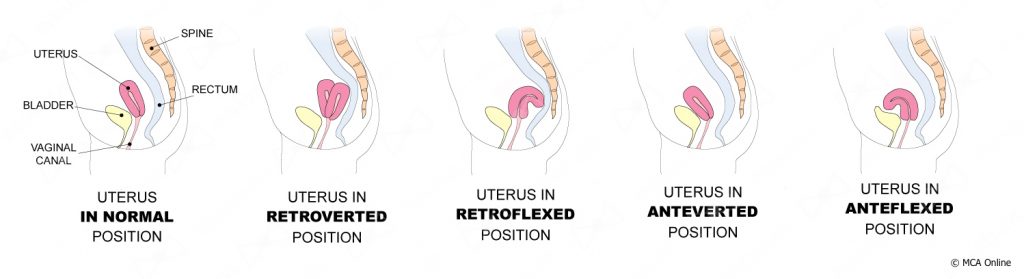 Different Uterus Positions MCA Online