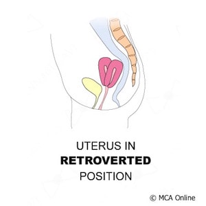 Tilted what is uterus a How a