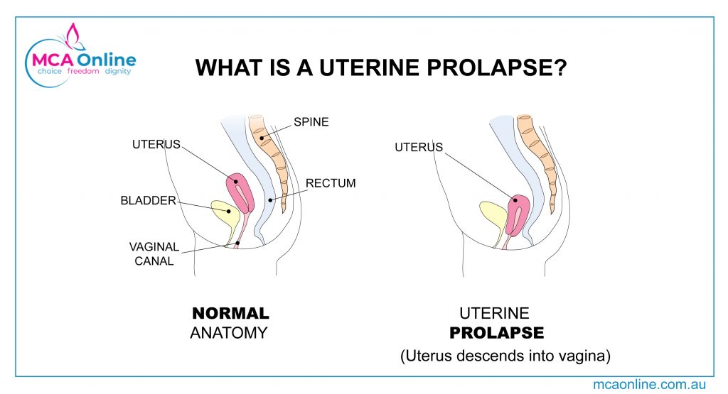 What is a uterine prolapse